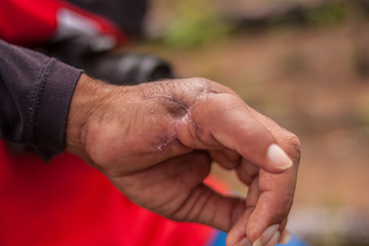 Un raspador de coca de Nueva Colombia muestra la cicatriz de su mano. MARIO TORO QUINTERO