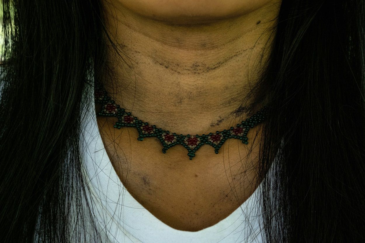 Cuello de Nidia Cansarí Dogiramá, superviviente de un intento de suicidio. MARIO TORO QUINTERO Cuello de Nidia Cansarí Dogiramá, superviviente de un intento de suicidio. MARIO TORO QUINTERO